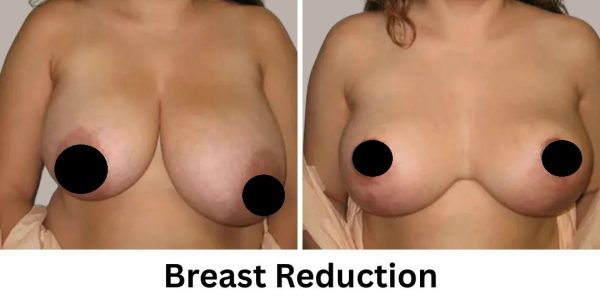 Plastic Surgery Westchester Results