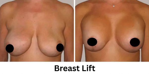 Plastic Surgery Westchester Results