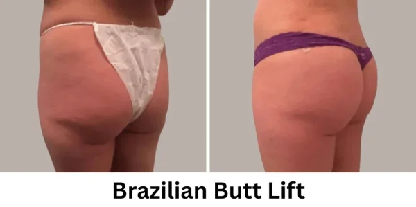 Plastic Surgery Westchester Results