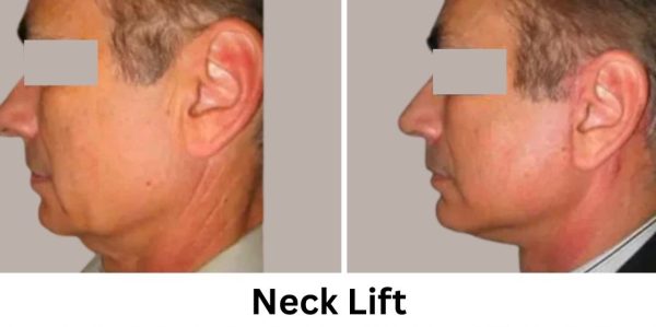 Plastic Surgery Westchester Results