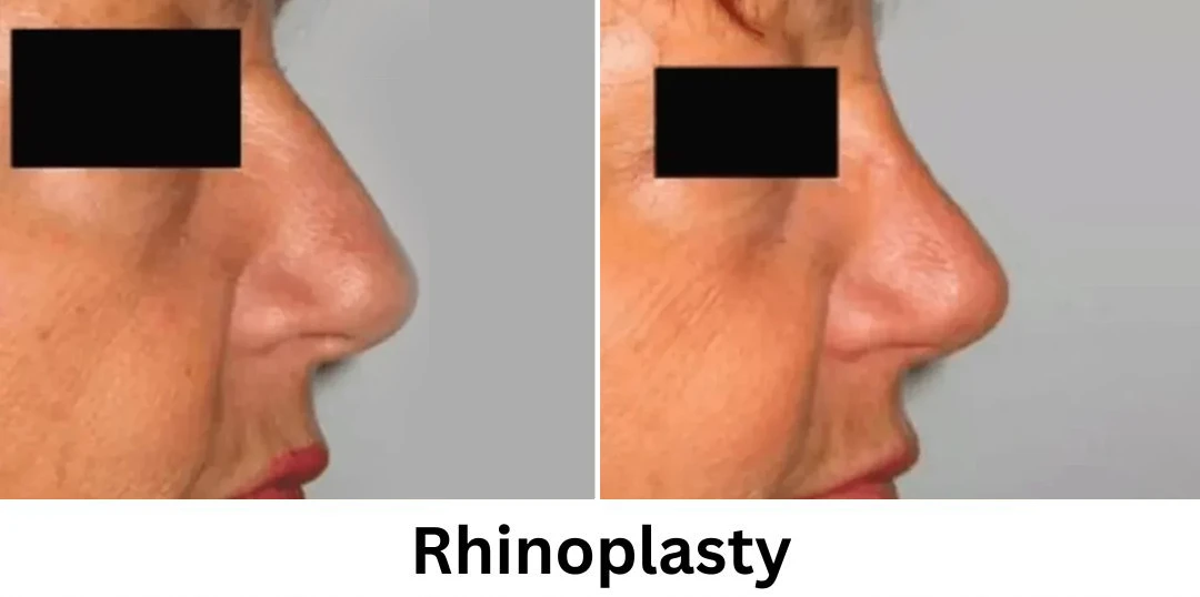 Plastic Surgery Westchester Results