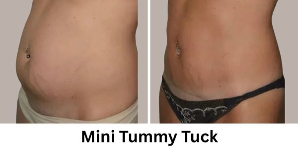 Plastic Surgery Westchester Results