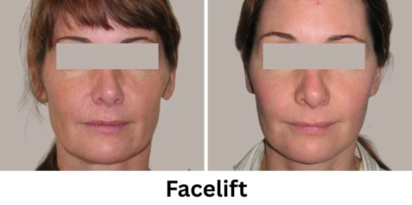 Plastic Surgery Westchester Results